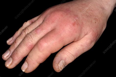 Cellulitis of the hand - Stock Image - C042/6302 - Science Photo Library