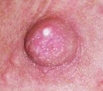 Milk blister pictures of blood, red , clear, or white spot on nipple breastfeeding