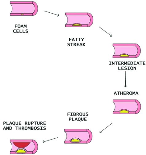 Steps of atheromatous plaque formation, progression, and rupture ...