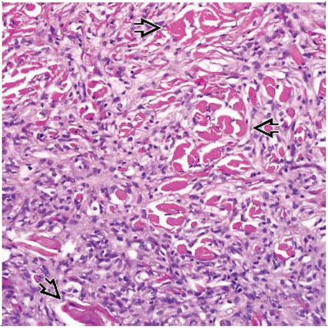 Dermatofibroma (Benign Fibrous Histiocytoma) | Basicmedical Key