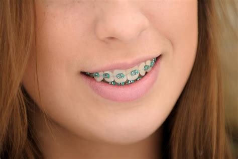 How Much Do Braces Cost? A Lot! Here Are 5 Ways to Protect Your Investment | Dental Health ...