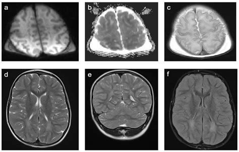 Characterization of MRI White Matter Signal Abnormalities in the Pediatric Population