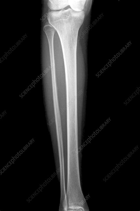 Lower leg bones, X-ray - Stock Image C001/7639 - Science Photo Library