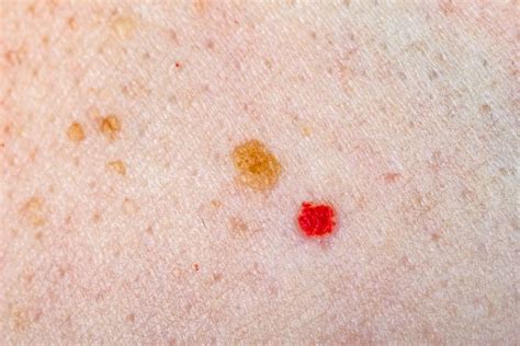 Tiny Red Blood Spots On Skin - Austra Health