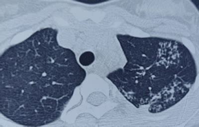 Tree in Bud Appearance: CT - Sumer's Radiology Blog