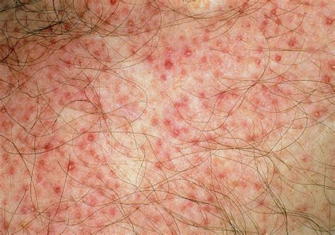 Close-up of red folliculitis papules on skin - Stock Image - M160/0044 - Science Photo Library