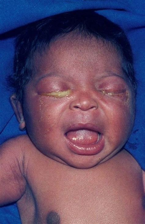 Conjunctivitis in Newborns - Children's Health Issues - MSD Manual ...