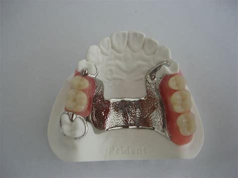 Rene Dental Lab: METAL PARTIAL DENTURES