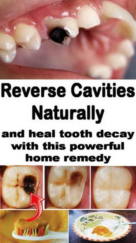 Reverse Tooth Decay Naturally At Your Home - Wellness Tips For You. #teethhealth #toothcavity ...