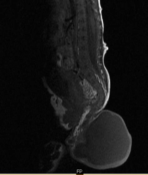 SACROCOCCYGEAL TERATOMA - Sumer's Radiology Blog