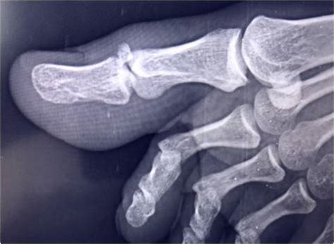 Types Of Fractures Toes at Doreatha Miller blog