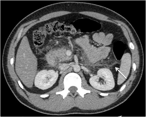 Figure 2 from A variation of colon cut off sign in acute pancreatitis and its mechanism: Double ...