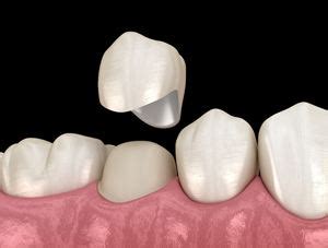 All-Ceramic Dental Crowns | Cosmetic Dentistry | Newington Dentist