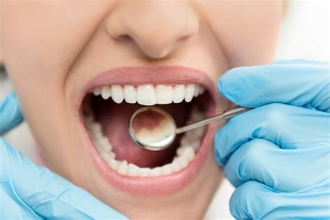 Caries dental: todo lo que necesitas saber - BeHealth