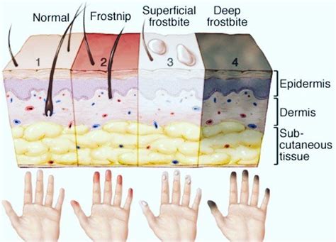 Do you know the difference between frostbite vs. frostnip? Do you know what you can do to ...