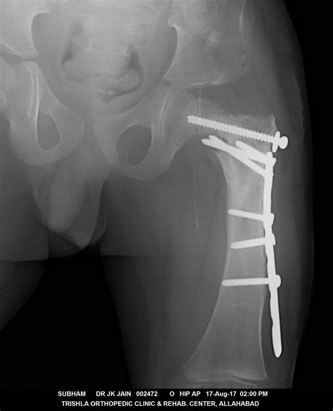 PFFD final xray Trishla Foundation - TrishlaFounation