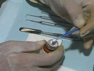 Glass Ionomer Cement Placement