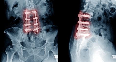 Spinal Fusion Surgery: why it might not fix your lower back pain - 2ser