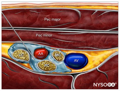 Reverse Ultrasound Anatomy for an infraclavicular brachial plexus block - NYSORA | NYSORA