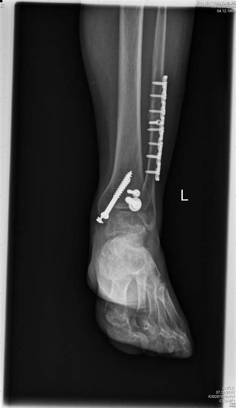 Fibula fracture - unionsalo