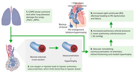 Cor Pulmonale | Concise Medical Knowledge