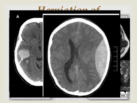 Increased intracranial pressure