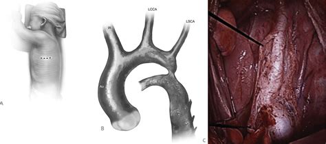 Aortic Coarctation Repair: How I Teach It - The Annals of Thoracic Surgery