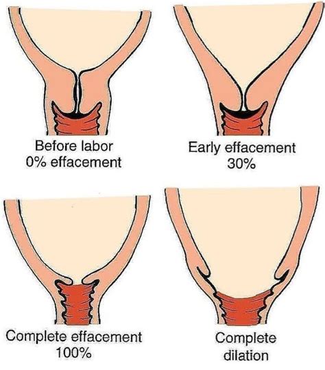 Cervical Effacement - MEDizzy