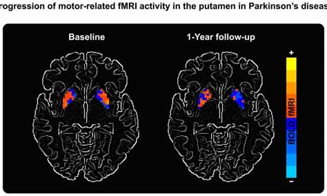 MRI Scans Showing Parkinson's Impact May Aid in Therapy Research