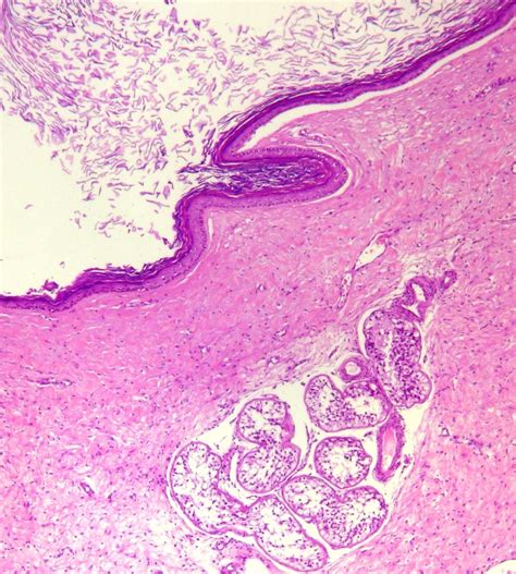 Epidermoid Cyst Histology