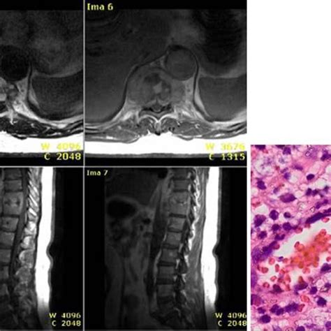 Pyogenic spondylitis, MRI and histology results. Notes: H and E ...