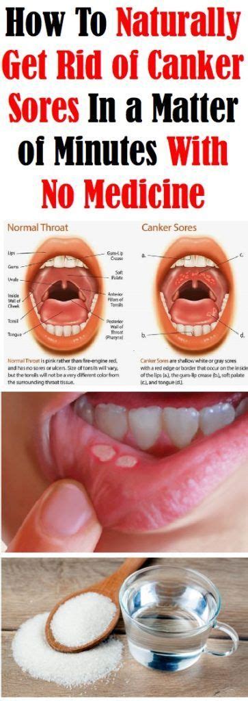 HOW TO NATURALLY GET RID OF CANKER SORES IN MINUTES WITH NO MEDICINE! - Viral Health | Canker ...