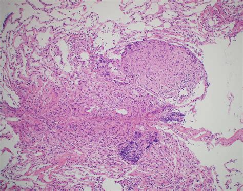 Histological findings of the lung. Histology demonstrated noncaseating ...