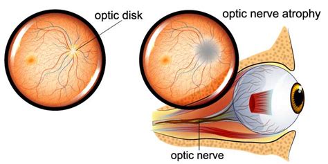 Optic Nerve Atrophy - Symptoms, Causes and Treatment | FYEyes