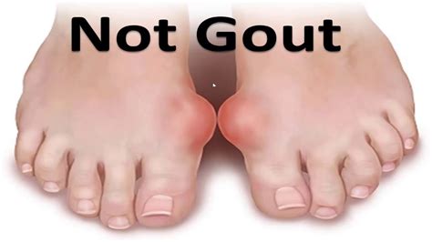 Gout in the big toe joint or the foot: *Complete Home Guide* - YouTube