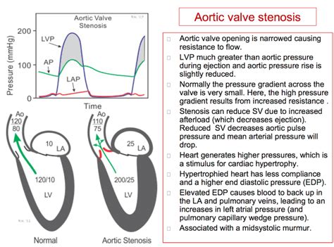 Aortic Valve Mean Pressure Gradient