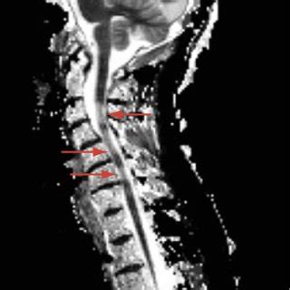 (PDF) Multiple sclerosis findings in the spinal cord