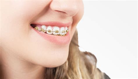 Factors to Consider Before Getting Gold Braces - Lalma