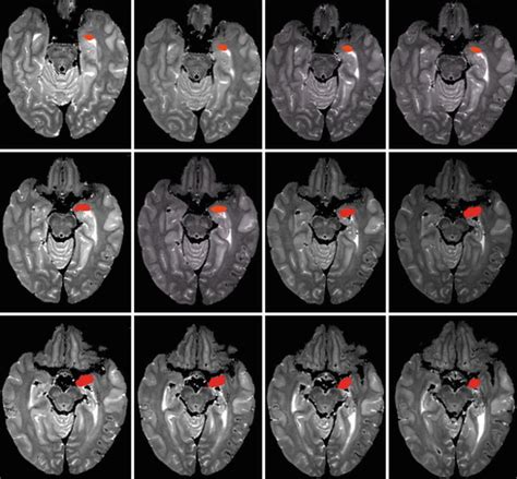 Morphology of the Human Amygdala | Radiology Key