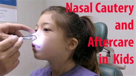 Pediatric Nosebleed Cauterization and Aftercare - YouTube