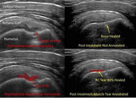 Rotator Cuff Tear Ultrasound