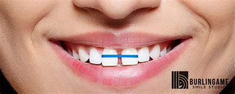 DIY BRACES: WHY YOU SHOULD NOT PARTICIPATE IN THE TREND - Burlingame Smile Studio