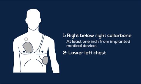 Guide to AED Pad Placement - MDPRO USA