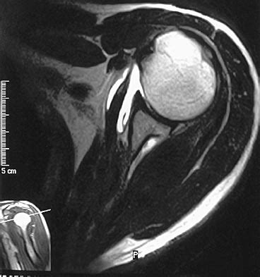 Rotator Cuff Tear Mri Arthrogram - cloudshareinfo