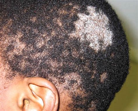 Tinea capitis scalp, causes, symptoms, diagnosis & tinea capitis treatment