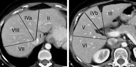 Couinaud Liver Segments in CT Scanner | Diagnostic medical sonography ...