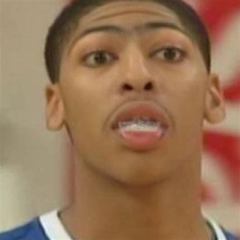 Anthony Davis Teeth Before And After