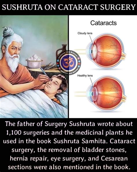 Sanatana Dharma™ on Instagram: “. SUSHRUTA ON CATARACT SURGERY . 1. A cataract causes the lens ...