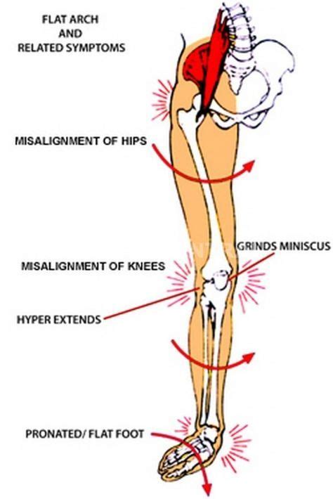 Is ‘Overpronation’ the cause of your running injury and can physiotherapy exercises help?