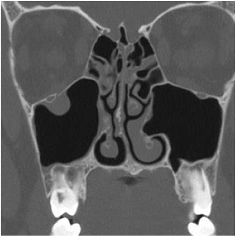 Coronal CT scan of the orbit which shows a blowout fracture in the... | Download Scientific Diagram